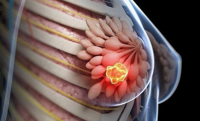 Khám và sàng lọc ung thư vú – Chủ động bảo vệ sức khỏe 
