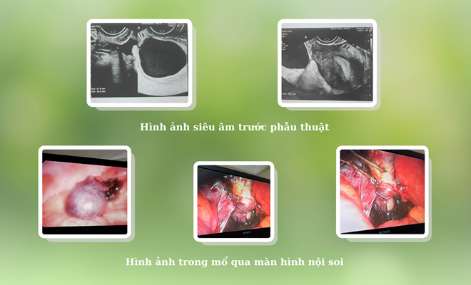 Đừng chủ quan với những cơn đau bụng bất thường: Ca xoắn vòi tử cung hiếm gặp tại Bệnh viện Phụ Sản Hà Nội