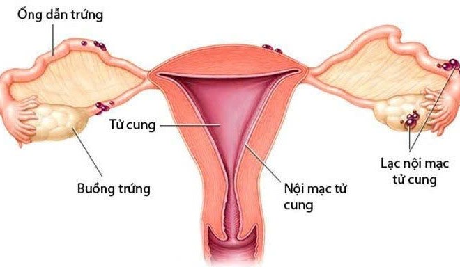 Lạc nội mạc tử cung có gây ra vô sinh hiếm muộn 