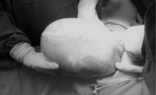 Một bé trong ca sinh đôi còn nguyên trong bọc ối lúc chào đời