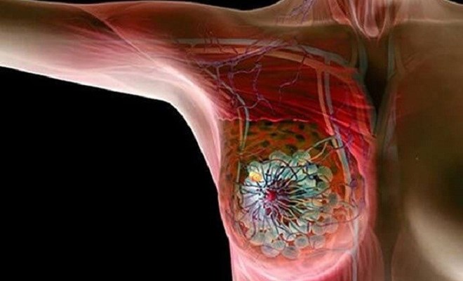 Phụ nữ nên cảnh giác với ung thư vú khi bước sang ngưỡng tuổi 30