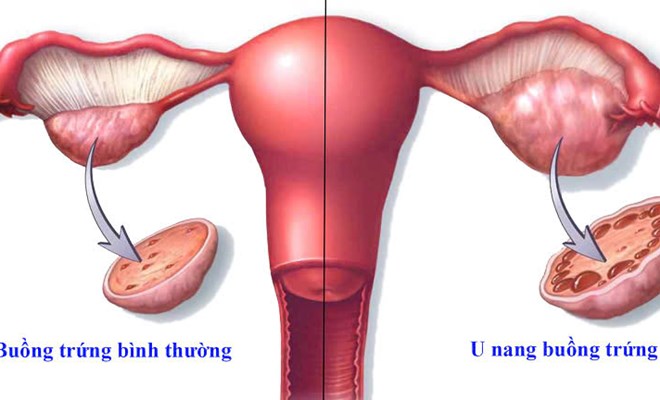 Các dạng U nang buồng trứng thường gặp