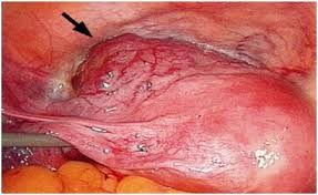 NHỮNG ĐIỀU CẦN BIẾT KHI ĐIỀU TRỊ CHỬA TRÊN SẸO MỔ ĐẺ