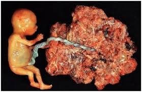 NHỮNG ĐIỀU CẦN BIẾT KHI ĐIỀU TRỊ THAI TRỨNG