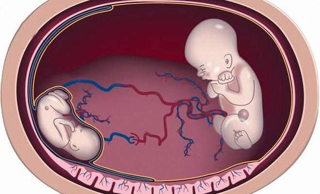 Hội chứng truyền máu song thai là gì?