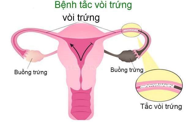 Hiếm muộn do tắc vòi trứng, chị em phải làm gì?