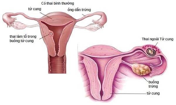 Mang thai ngoài tử cung lặp đi lặp lại có phải là ‘dớp’?