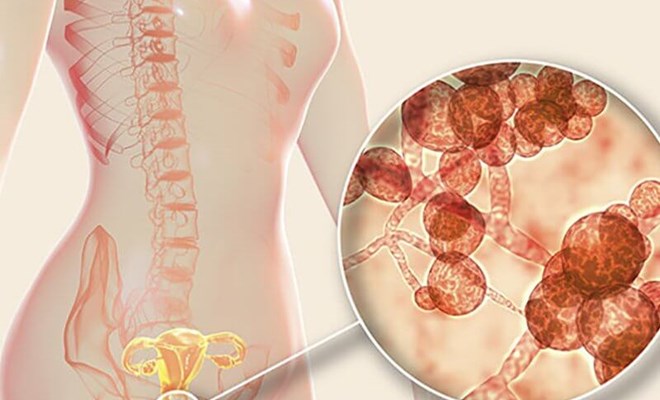 Cảnh báo các dấu hiệu mắc bệnh nấm âm đạo