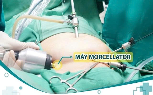 Phẫu thuật nội soi bóc u xơ tử cung với thiết bị hỗ trợ 